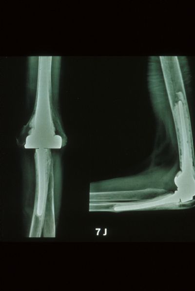 Souter-Strathclyde Total Elbow Prosthesis (Implant 95)